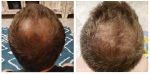 photo of male hair growth before and after