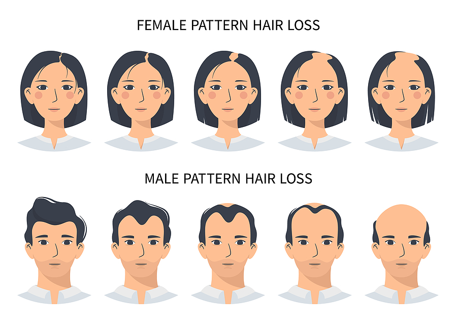 graphic chart of female and male pattern hair loss