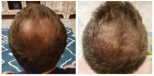 man before and after hair loss photos